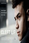 Cleft Lip